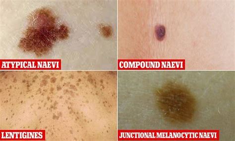 The Six Most Common Moles Revealed And How To Tell These Apart Mole