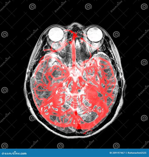 Mra Magnetic Resonance Angiography Of Brain For Stroke Patient Stock