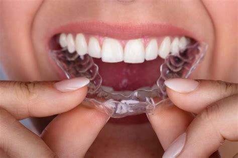 Apr 16, 2018 · this is why most orthodontists will require you to wear your removable retainers for at least 12 months following your braces removal. How Long Do I Have to Wear a Retainer After I Have Braces?