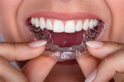 Most often, a retainer must be worn continuously for a period of 6 months or more following the removal of the aligners or braces. How Long Do I Have to Wear a Retainer After I Have Braces?