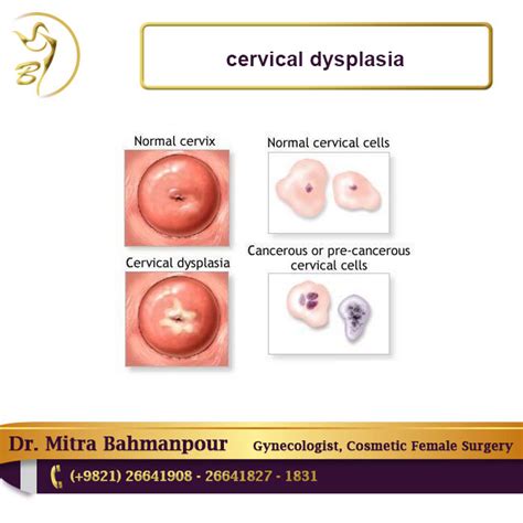 Uterine cancer treatment often includes a hysterectomy to remove the uterus (womb). cervical dysplasia | cervical dysplasia symptoms ...