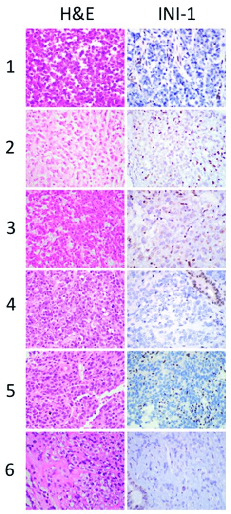 Malignant Rhabdoid Tumor Mrt Showing Small Cell Morphology A Case