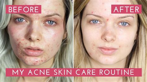 My Acne Skin Care Routine How I Cleared My Acne Mypaleskin Youtube