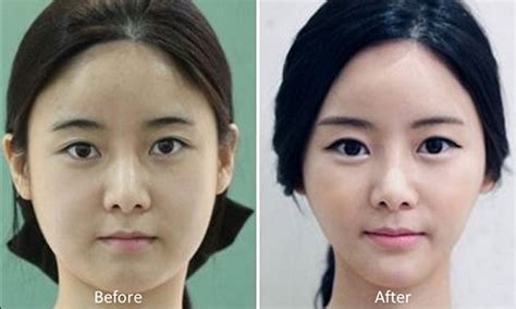 Korean Plastic Surgery Before And After Gone Wrong