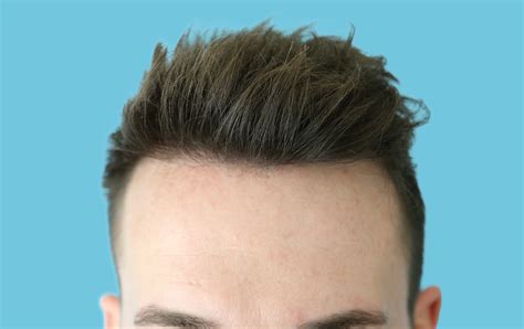 BEFORE AND AFTER FUE HAIR TRANSPLANT