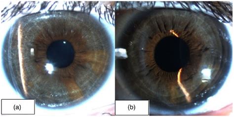 Bilateral Acute Depigmentation Of Iris 3 Year Follow Up Of A Case