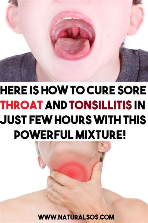 How To Fix Swollen Tonsils Swollen Tonsils In Most Conditions
