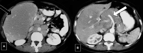 Axial Contrast Enhanced Ct Images Ab Showing Diffuse Infiltration Of