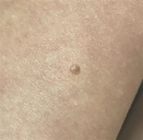 So I Just Noticed This New More Flesh Colored Mole On My Leg Today It