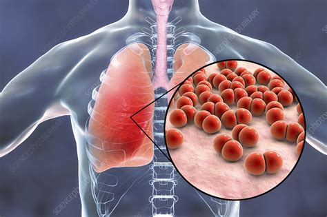 Pneumonia Caused By Streptococcus Pneumoniae Bacteria Conce Stock