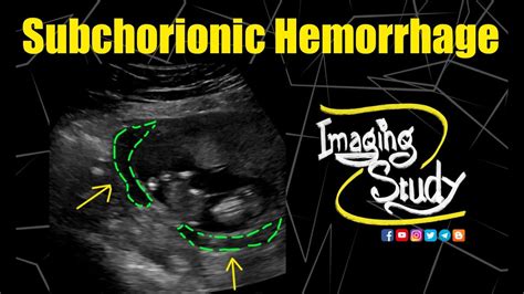 Subchorionic Hemorrhage Ultrasound Case 193 Youtube
