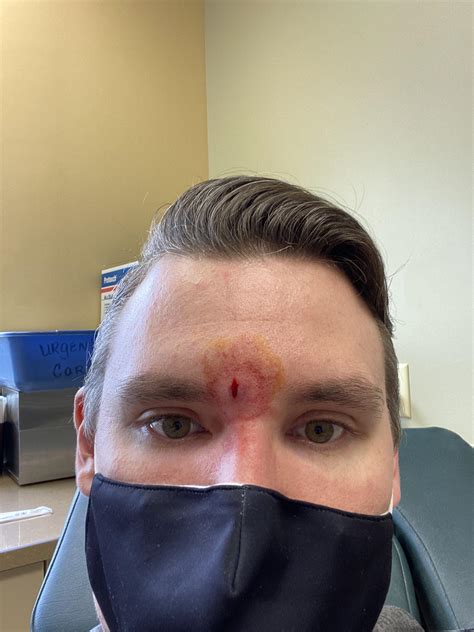 Second Time In Six Years Having To Get A Cyst Removed From My Face In