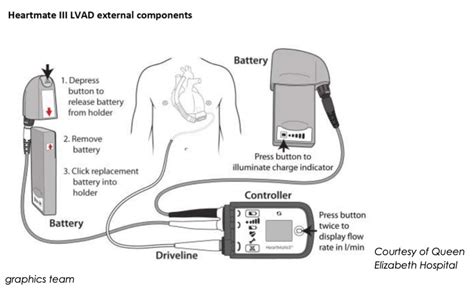 Left Ventricular Assist Devices In The Emergency Department Rcemlearning