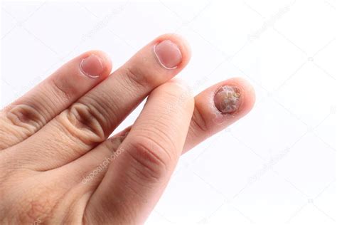 Infección Por Hongos En Las Uñas De La Mano Dedo Con Onicomicosis