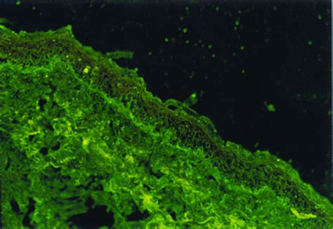 Lichen Planus Pemphigoides Direct Immunofluorescence Showing Linear