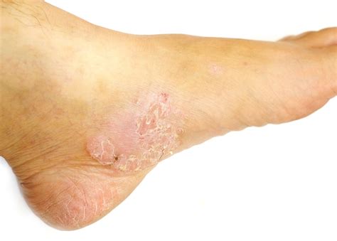 Dyshidrotic Eczema Bottom Of Foot