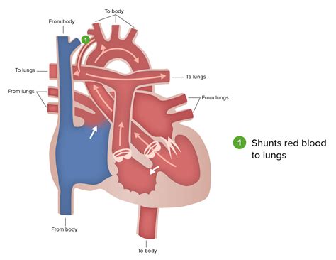 Hypoplastic Left Heart Syndrome Hlhs Concise Medical Knowledge