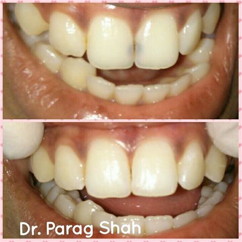 Creating Smiles Front Teeth Black Spot Decay