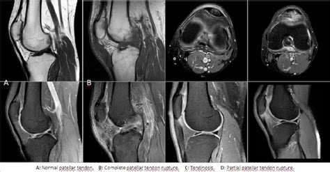 Figure 2 From MRI OF THE KNEE Normal And Abnormal Findings Semantic