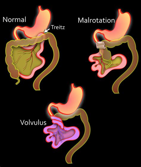 It is different from tendon, which connect muscle to bone. The Radiology Assistant : Acute Abdomen in Neonates