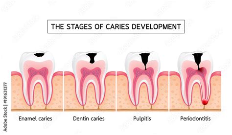 Stages Of Caries Development Enamel Caries Dentin Caries Pulpitis