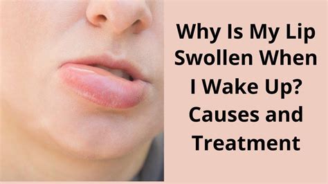 What Is Lip Gland Swelling Know Its Causes Symptoms Treatment Images