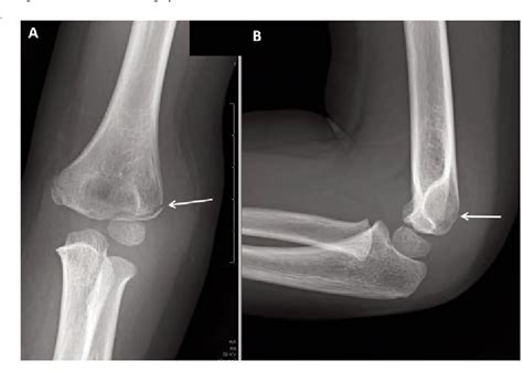 Figure 2 From Radiographic Evaluation Of Common Pediatric Elbow