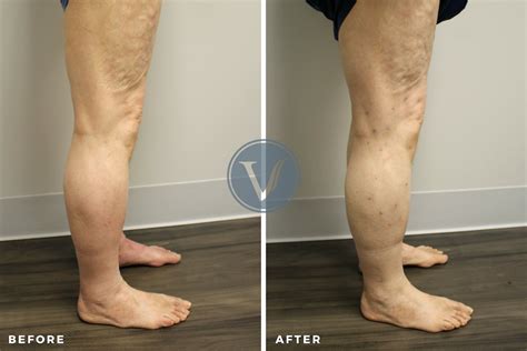 Treatment For Dvt And Varicose Veins The Vein Institute At Ssa