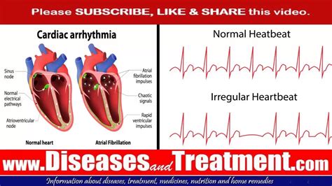 Abnormal Heart Rhythm Arrhythmia Pictures