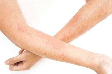 Dermatite Allergica Da Contatto X115®