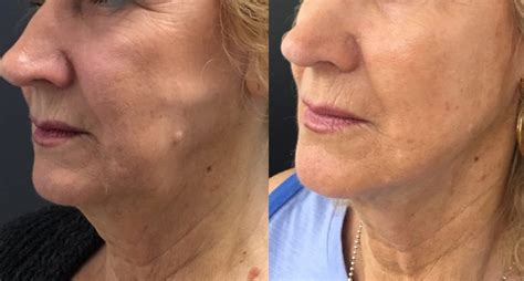 Non Surgical Jowl Lift Thread Lift Hifu Injectables For Jowl And Jowl