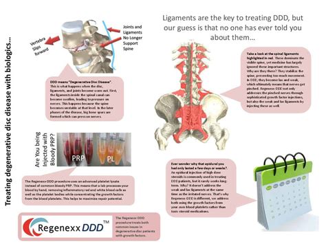 Regenexxddd Procedure Infographic Pdf Regenexx® At New Regeneration