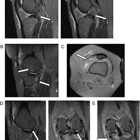 Sagittal Cuts Of Magnetic Resonance Imaging Mri Of The Left Knee