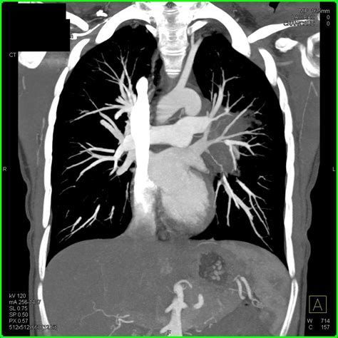 Lymphoma Involves The Chest Wall Chest Case Studies Ctisus Ct Scanning