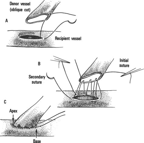 Continuous Suturing For Microvascular Anastomosis In Journal Of