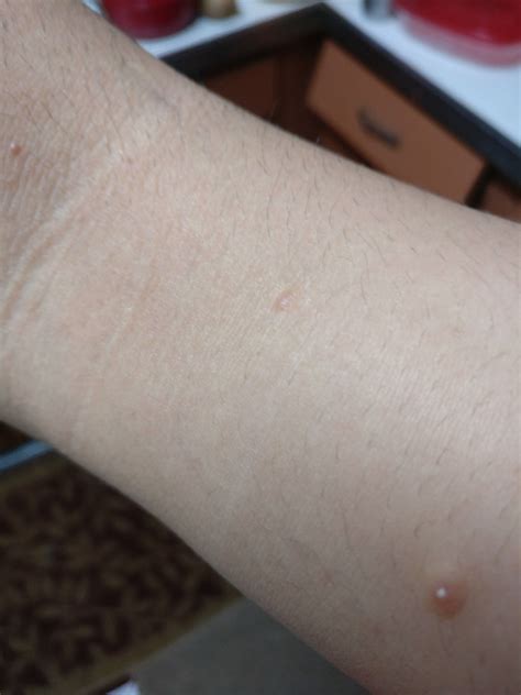 What Is This Ive Had This Pimple On My Arm For A Few A While Now