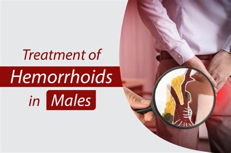 treatment of hemorrhoids in males symptoms of hemorrhoid in male