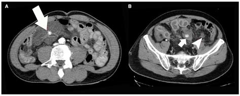 Abnormal Abdominal Ct Scan Icd 10
