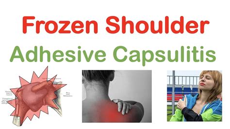 Frozen Shoulder Adhesive Capsulitis Causes Symptoms Stages