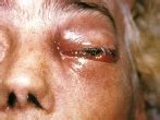 Patients with mucormycosis should be treated in a tertiary care center with subspecialty units experienced in the management of this condition and its underlying risk factors. Mucormycosis. Causes, symptoms, treatment Mucormycosis