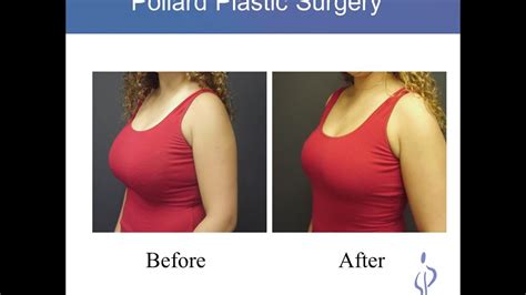 Breast Uplift Before And After Naked Photo