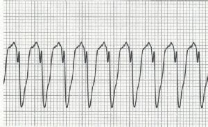La fibrillazione ventricolare è una forma grave di aritmia cardiaca, una sequenza scoordinata di rapide contrazioni ventricolari causata da impulsi elettrici. Forte Ancona dp Fondamenti per la defibrillazione precoce