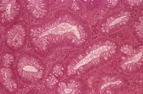 Intestinal Polyp Light Micrograph Stock Image C0227223 Science