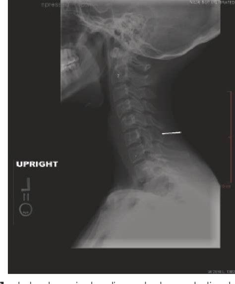 Figure 1 From Chondromyxoid Fibroma With Secondary Aneurysmal Bone Cyst