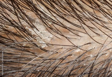 Dandruff In The Hair And Scalp Macro Shot Stock Photo Adobe Stock