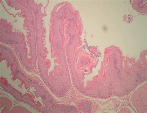 Squamous Papilloma Is An Exophytic Lesion Which Shows Typically