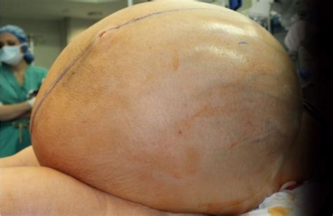 Ovarian Tumor 132 Pound Mass Removed From Womans Abdomen The