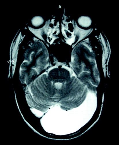 Conversion Disorder In A Patient With Posterior Fossa Arachnoid Cyst
