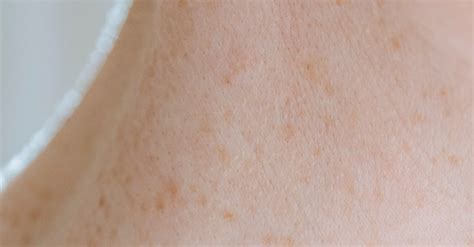 Skin With Brown Spots On Neck Of Crop Person · Free Stock Photo