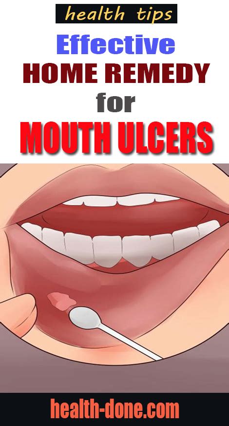 15 Home Remedies For Mouth Ulcers Honey And Coconut Milk Theraphy 2